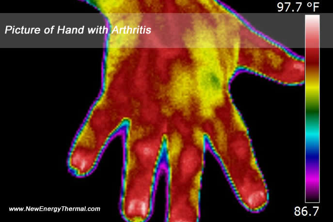 Hand with Arthritus